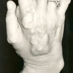 Fig. 1-B Photograph of the dorsum of the right hand, showing multiple calcified nodular lesions.
