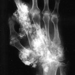 Fig. 2 Anteroposterior radiograph of the right hand, showing multiple mineralized masses.
