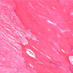 Fig. 3-A Surgical pathology specimen consisting of excised nodular tissue, showing fibrous tissue (left) adjacent to sheet-like aggregates of woven bone (right) (hematoxylin and eosin stain).
