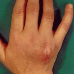 Fig. 1 Photograph of the lesion at presentation.
