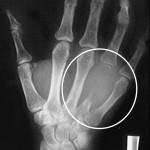 Fig. 2  Anteroposterior radiograph of the right hand at presentation.
