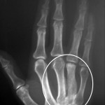 Fig. 4 Anteroposterior radiograph of the right hand after one year of vitamin-D treatment.
