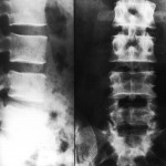 Fig. 1 Anteroposterior and lateral radiographs of the lumbosacral spine, showing no apparent abnormality except for a loss of sharpness of the margins of the laminae of the fourth lumbar vertebra.
