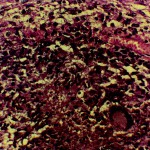 Fig. 4 Photomicrograph of the specimen obtained at surgery revealing typical tubercular granuloma with Langhans giant cells, epithelioid cells, and round cells (×400).

