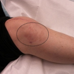 Fig. 1 Skin lesion adjacent to the knee at the time of presentation.
