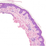 Fig. 2-A Histological findings under hematoxylin and eosin staining showed normal-appearing epidermis with marked dilated capillaries predominantly in the papillary dermis (4× magnification).
