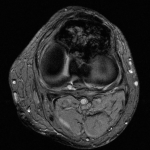 Fig. 1-A Axial T2-weighted MRI of the left knee demonstrating a large intra-articular mass compatible with PVNS, centered on the Hoffa fat pad.
