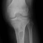 Fig. 2-A Anteroposterior radiograph of the left knee two years after initial presentation demonstrating erosion of the anterior tibial plateau and tibial tuberosity with an anterior tibial metaphyseal lesion.
