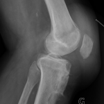 Fig. 2-B Lateral radiograph of the left knee two years after initial presentation demonstrating erosion of the anterior tibial plateau and tibial tuberosity with an anterior tibial metaphyseal lesion.

