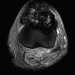 Fig. 3-A Axial T2-weighted MRI two years after initial presentation showing important progression of the intra-articular mass and erosion of the patellar tendon and anterior aspect of the proximal part of the tibia.
