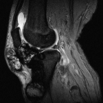 Fig. 3-B Sagittal T2-weighted MRI two years after initial presentation showing important progression of the intra-articular mass and erosion of the patellar tendon and anterior aspect of the proximal part of the tibia.
