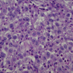 Fig. 4-A Photomicrograph of the left knee specimen (high-power magnification with hematoxylin and eosin stain).
