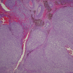 Fig. 4-B Photomicrograph of the left knee specimen demonstrates brown areas consistent with hemosiderin deposition (low-power magnification with hematoxylin and eosin stain).

