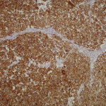 Fig. 4-C Photomicrograph of the left knee specimen under high-power magnification with cytokeratin AE1/AE3 stains.
