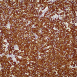 Fig. 4-D Photomicrograph of the left knee specimen under high-power magnification with cytokeratin CAM 5.2 stains
