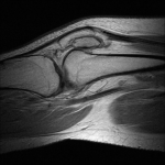 Fig. 1 Sagittal proton density fast spin echo (1.5 T) MRI of the right knee demonstrating the connective tissue insertions into the anterior patellar fragment. The posterior patellar fragment lacks any attachment to the extensor mechanism; a prominent medial plica is visualized near the inferior pole.
