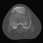 Fig. 2 Axial CT of the right knee demonstrating two patellar layers and normal patellofemoral joint width.
