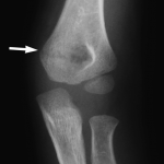 Fig. 1 Nondisplaced supracondylar fracture of the left elbow (arrow) when the patient was five years old.
