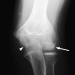 Fig. 2-A Radiograph showing an irregularly contoured ossification of the capitellum (arrow) and sparse ossification of the medial trochlea (arrowhead).
