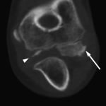 Fig. 2-B Coronal CT confirming oblique ossification of the medial trochlea (arrowhead) and an irregular contour of the capitellum (arrow).
