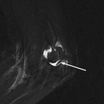 Fig. 3-A MRI of the elbow showing an abnormal shadow (arrow) with low-intensity signals in the ulnohumeral joint on a T2-weighted sagittal image.
