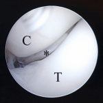 Fig. 4-A Arthroscopic findings through the anteromedial portal. The cartilage flap (*) was attached to the trochlea, and was drawn into the ulnohumeral joint when the elbow was flexed. C = coronoid process and T = humeral trochlea.
