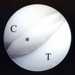 Fig. 4-B Arthroscopic findings through the anteromedial portal. The cartilage flap (*) extended to and interposed within the joint when the elbow was extended. C = coronoid process and T = humeral trochlea.
