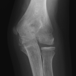 Fig. 5-A Sequential radiograph of the elbow after surgery (cartilage flap resection). Several sparse ossifications and sclerosis are shown in the medial condyle two months (patient age, eleven years, one month) after surgery. The condition had progressed to a complete fishtail deformity in the trochlea after the epiphyseal closure.
