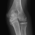 Fig. 5-B Sequential radiograph of the elbow at six months (patient age, eleven years, five months) after surgery (cartilage flap resection).
