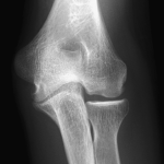 Fig. 5-C Sequential radiograph of the elbow at thirty months (patient age, thirteen years, five months) after surgery (cartilage flap resection).
