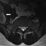 Fig. 1 MRI of the lumbar spine. The mass within the iliac is muscle (arrow).
