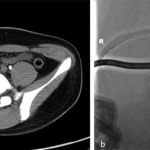 Fig. 2 Fig. 2-A CT-guided percutaneous drainage (arrow) of the hematoma was performed. Fig. 2-B The final position of the drainage tube is shown.
