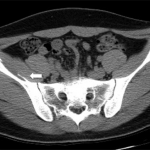 Fig. 3 The six-month posttreatment CT scan shows a resolved iliacus hematoma with a calcified wall abutting the right iliac bone (arrow).
