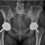 Fig. 1 Anteroposterior pelvic radiograph shows bilateral hip resurfacing arthroplasties with satisfactory alignment.

