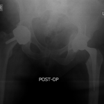 Fig. 3 Anteroposterior radiograph after the revision left hip arthroplasty.
