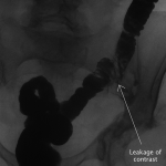 Fig. 4 A repeat gastrografin enema revealed leakage of contrast from the sigmoid colon into the left iliac fossa, consistent with a fistula.
