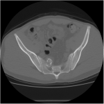 Fig. 1-A Preoperative noncontrast CT study of the pelvis: axial view
