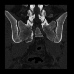 Fig. 1-B Preoperative noncontrast CT study of the pelvis: coronal view.
