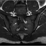 Fig. 2 Preoperative T1-weighted MRI of the sacrum showing a low-signal-intensity lesion encroaching on the right S1 neural foramen (arrow).
