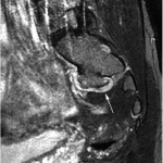 Fig. 3-A Preoperative MRI of the lumbosacral region. Contrast-enhanced T2-weighted sagittal view showing an anteriorly located, intermediate-intensity mass compressing the S1 nerve root (arrow) as it exits the neural foramen.
