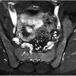 Fig. 3-B Preoperative MRI of the lumbosacral region. Contrast-enhanced T2-weighted axial view of the pelvis showing the S1 nerve root lying superficial to the osseous mass arising from the right hemisacrum (arrow).
