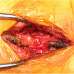 Fig. 4-B Intraoperative photograph of a posterior decompression demonstrating the posterior S1 nerve root.

