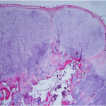 Fig. 5-A Low-magnification histologic image of a well-circumscribed periphery and hyaline cartilage maturing into trabecular bone (hematoxylin and eosin stain, 20× magnification).
