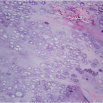 Fig. 5-B High-magnification histologic image of chondrocytes in a columnar pattern with nuclei lacking pleomorphism, nuclear hyperchromasia, or binucleation (hematoxylin and eosin stain, 40× magnification).
