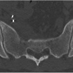 Fig. 6 Postoperative noncontrast axial CT after completion of both surgical stages showing the pelvis at the level of the S1 body with the normal osseous contour of the anterior sacrum.
