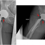 Fig. 1 Anteroposterior (left) and lateral (right) radiographs demonstrating a collection of gas within the hip joints (arrows).
