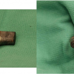 Fig. 3 Intraoperative images of the extracted titanium modular neck demonstrating hallmark signs of corrosion.
