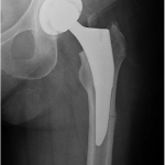 Fig. 1 Three-week postoperative anteroposterior left hip radiograph showing the thickened lateral diaphyseal cortex with “beaking” and a transverse fracture line about the distal third of the femoral prosthesis.
