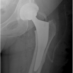Fig. 2-B Immediate postoperative anteroposterior left hip radiograph showing subtle thickening of the lateral diaphyseal cortex.

