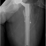 Fig. 3 Immediate postoperative anteroposterior left hip radiograph showing the revision femoral prosthesis bypassing the proximal femoral cortical fracture.
